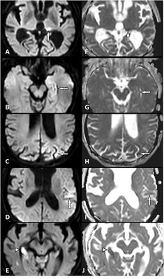 Quantitative Analysis of Diffusion-Restricted Lesions in a Differential Diagnosis of Status Epilepticus and Acute Ischemic Stroke